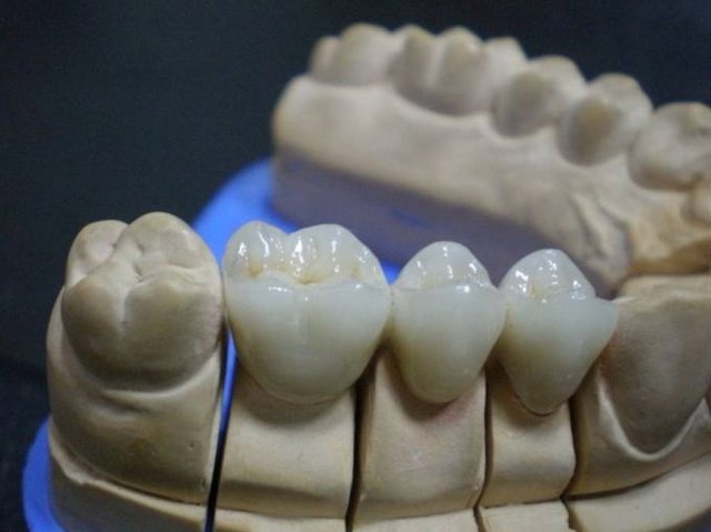 Certum restitutio Vesalius Traditional Opus ab initio ad finem in Dental Lab corona et pontem