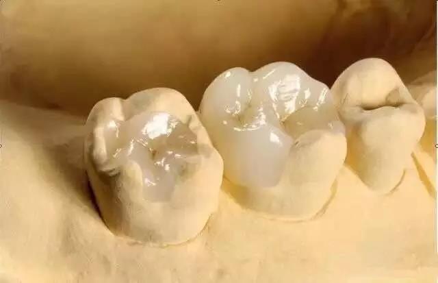 Zirconia dentalis Inlay pro Salvage Small Superficies Defectus Naturae Tooth