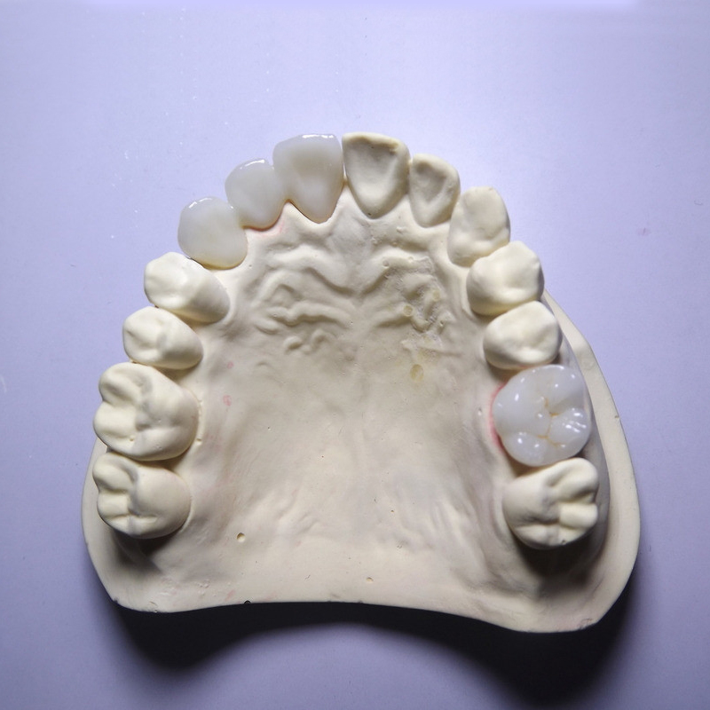 Quare corona zirconia est optimum?