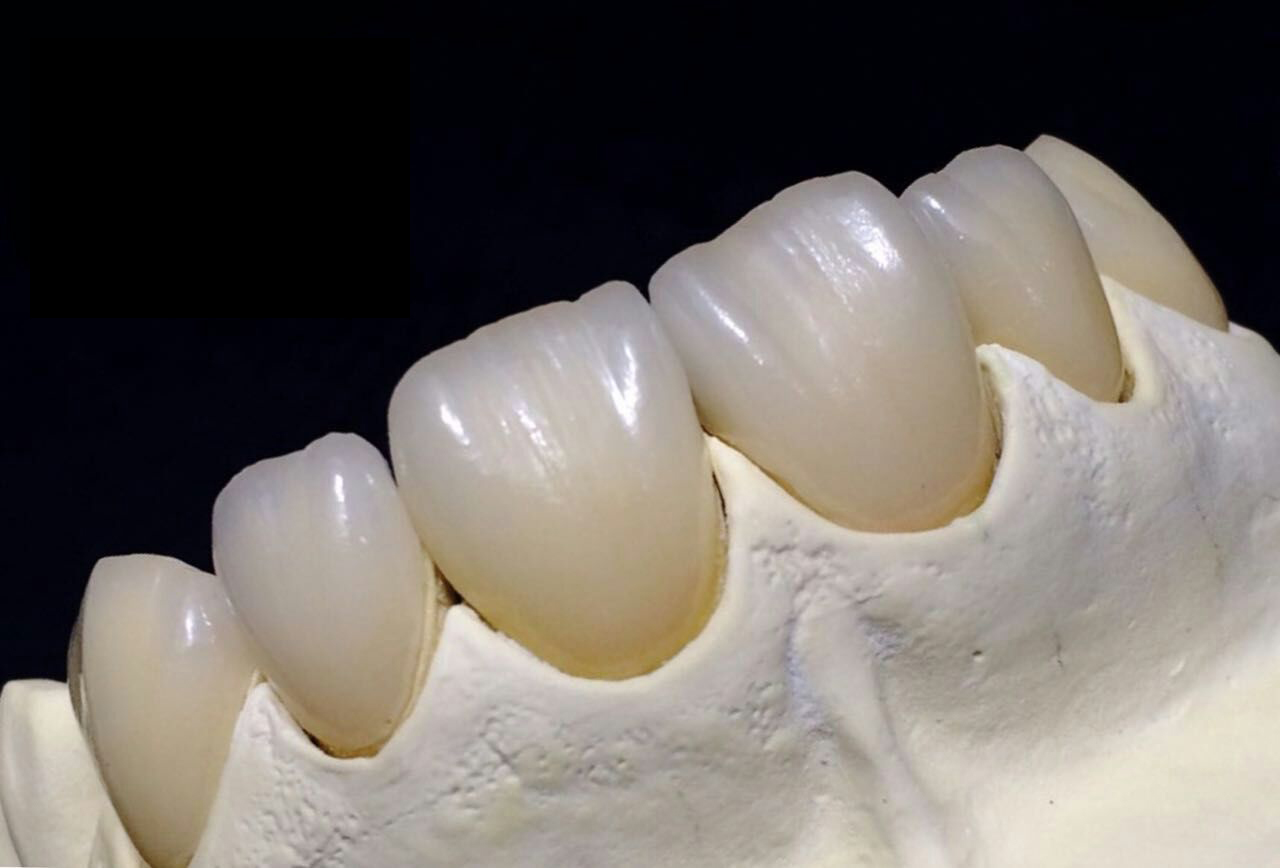 Cautio de zirconia dentium fictilem