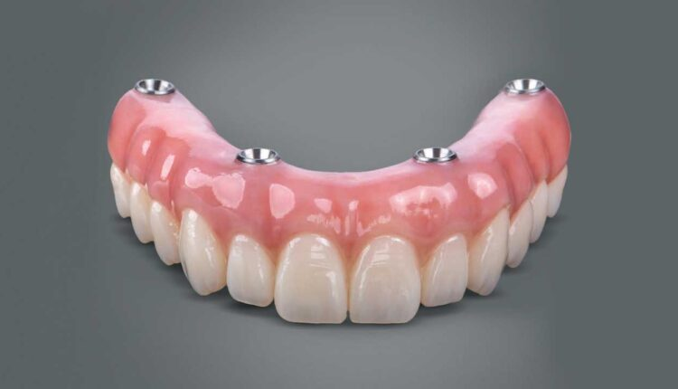 Dentalis restitutiones implantare, quousque durat?