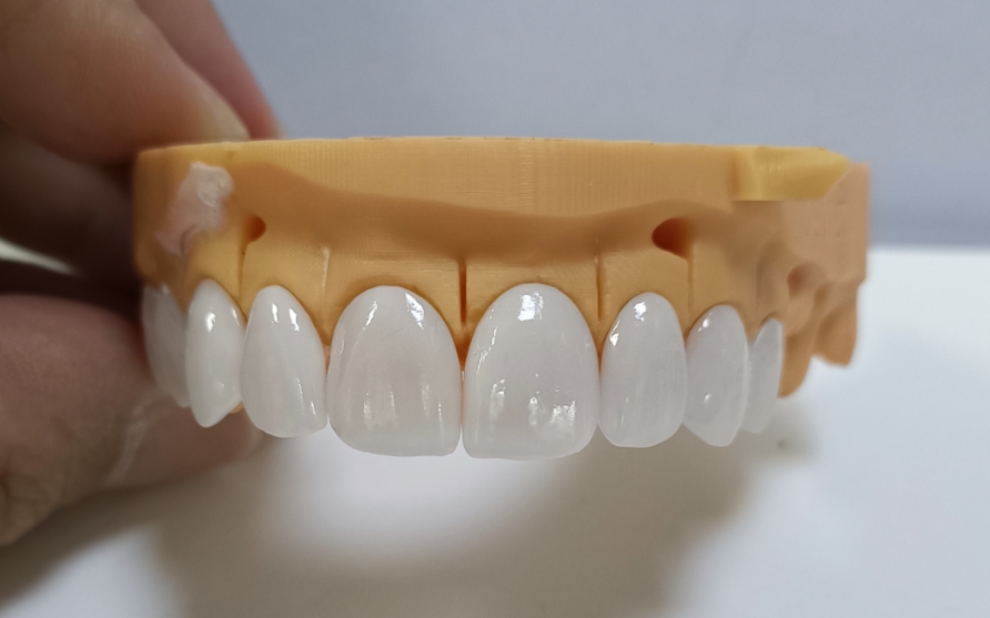 Princeps Esthetic Emax Veneers