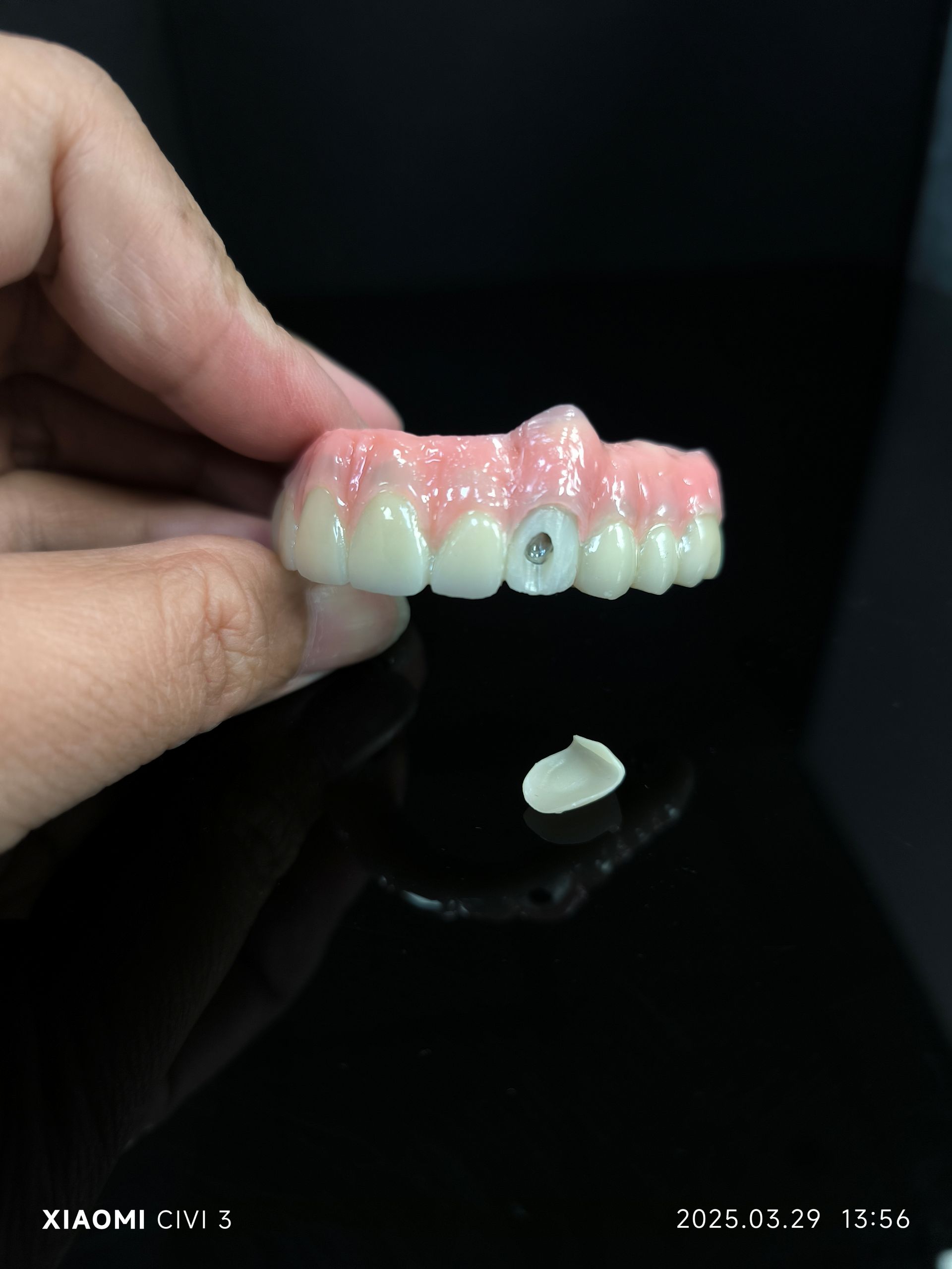 Omnes in IV Hybrid - Hybrid Zirconia pontem solution pro vestibular stupra foraminis