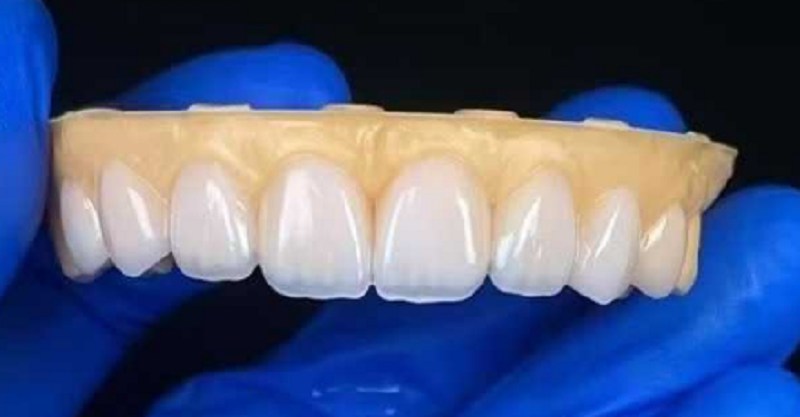 Dental Veneers ad reparare problema nimia dente gaps
