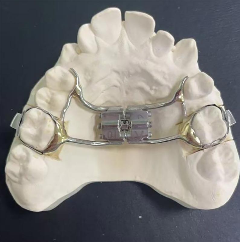 Quid est celeri maxillary Expander (RME)?