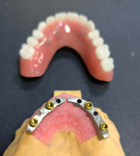 Locator et Titanium Dental Bar