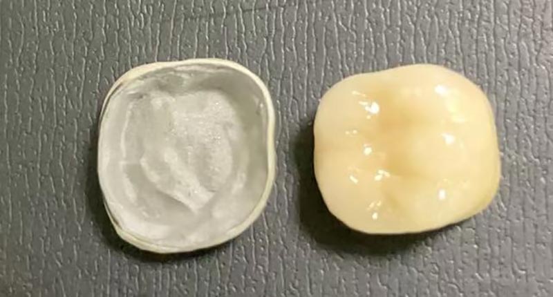 Quid facere cum Porcelain corona Chips? Hic est quare Hoc accidit & quomodo figere It