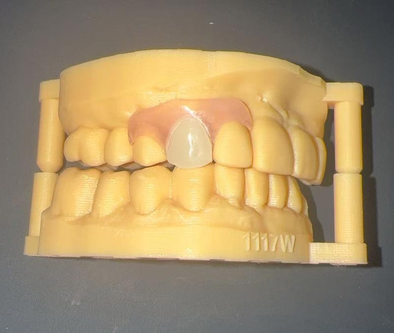 Flexibilis Partialis Denture: Restoratio Aesthetica & Consolatoria per Lab & WM Dental Sinenses Dental Lab
