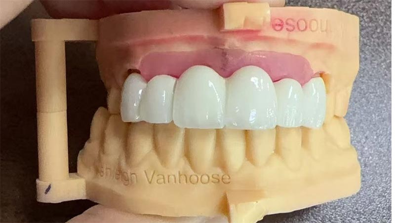Trianguli nigri in Orthodontic Treatment