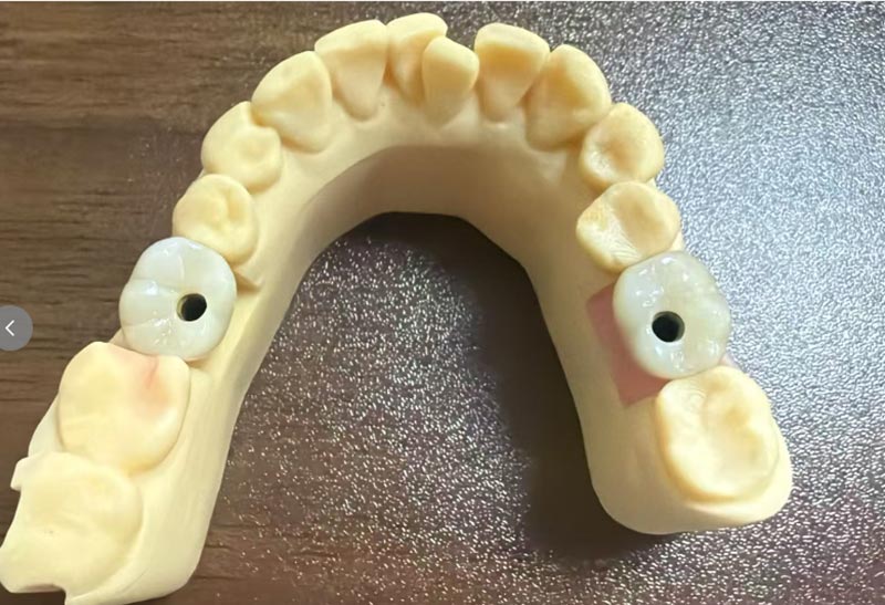 Quare difficilius est frons dens implantatio quam posterius dens implantatio?