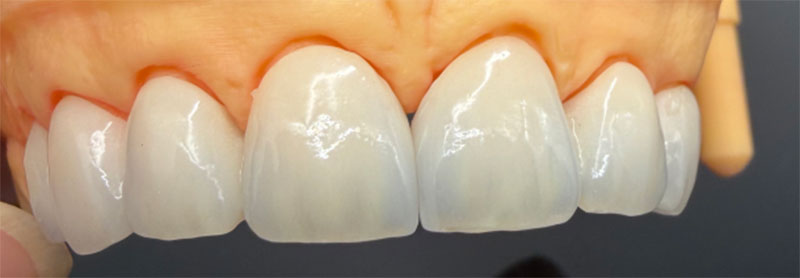 Incussus Non Vitalis dentes in omnia Ceramic coronae et correspondentes treatments