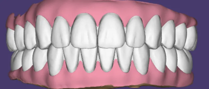 Design for Removable Dentures