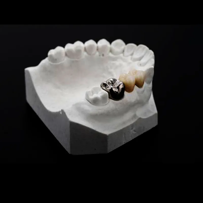 Quando Clinicians Elige Coronam Metallicam pro Posterioribus Restorationibus?