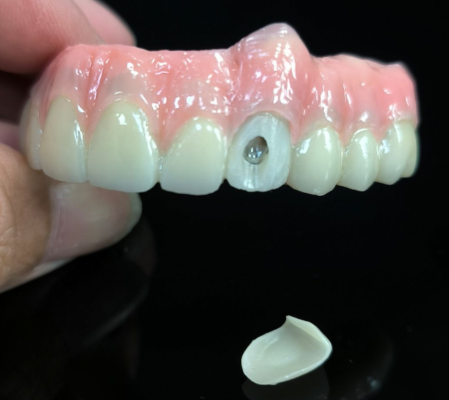 Omnes in IV Hybrid - Hybrid Zirconia pontem solution pro vestibular stupra foraminis