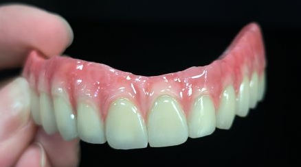 Omnes in IV Hybrid - Malo pontem plena Zirconia coronat Titanium structuram