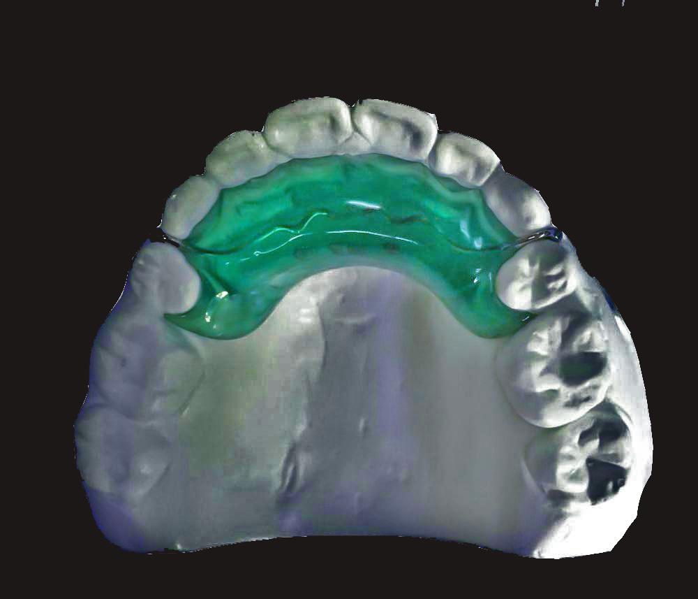 Anterior inclinati Bite Planum