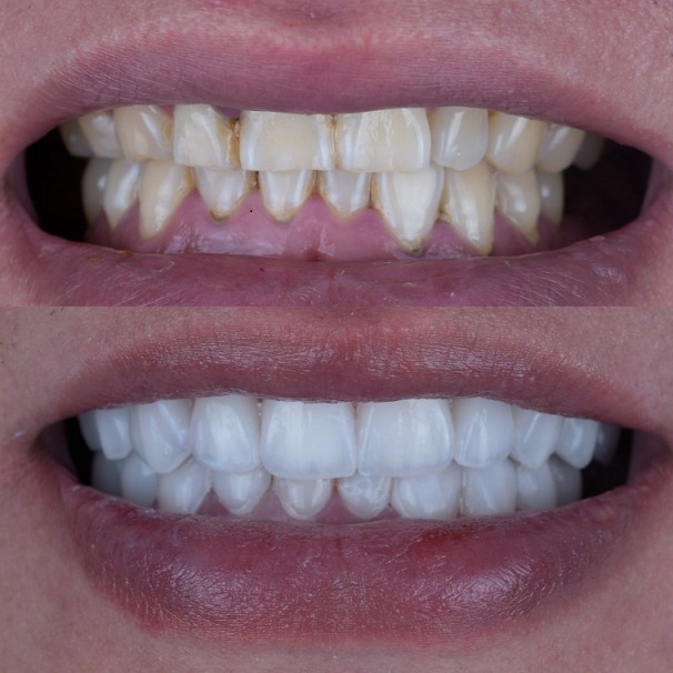 Emax Stratum Veneers Esthetic Sinis Dental Lab opus