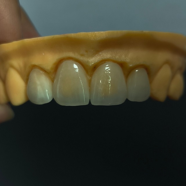 Princeps Translucens dentalis Veneers Stratum Emax Veneer