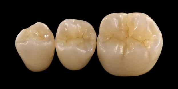 <h2>Zirconia in Dentistry: Indicia, Commoda, Ac Considentia Fusce</h2>
<p>Zirconia propter vim et vetustatem late cognoscitur. Ultimae generationes materiae zirconiae etiam proprietatibus aestheticis insigniter auctis offerunt. Aegris considerantibus restitutiones omnes ceramicos, necesse est diligenter aestimare tum indicia et limites systematis zirconiae-substructi.</p>
<p>Hodie aegroti magis magisque exspectant restitutiones quae optimas aestheticas cum plena operatione functionis coniungunt. Pleraque modernae systemata ceramica his exspectationibus occurrere possunt, sed successus clinicus late pendet a propria electione materiali, praeparatione dente et protocolla caementatione. Electio debet sequi proprietatibus materialibus clavis ut fractura resistentia, vires flexus, resistentia induere, stabilitas diuturna. Inter has materias, zirconia una e optionibus maxime adhibitis in dentist restaurativa restaurativa hodierno facta est.</p>
<h3>Quid elige Zirconia?</h3>
<p>Zirconia aestimatur propter eximiam virtutem et diuturnitatem temporis. Zirconia moderna signanter differt a prioribus generationibus, quae magis opaca et minus aesthetica erant. Hodie, CAD/CAM technicae artis zirconiae restitutiones cum melioribus proprietatibus opticis fabricandis accuratam efficit.</p>
<p>Restaurationes possunt designari sicut:</p>
<ul>
<li><strong>Monolithic zirconia:</strong>Specimen pro coronis et pontibus posterioribus, altum robur et vetustatem offerens.</li>
<li><strong>Nunc zirconia;</strong>Apta causa requirunt aesthetica aucta, inclusa restitutiones longi temporis per varias oris areas.</li>
</ul>
<p>Vires flexiles secundum genus variat, ab circiter 590 MPa in zirconia alta translucentia usque ad 1400 MPa in formis monolithicis. Redundationes zirconiae componi possunt utens cementa resinae sui tenaces vel caementa ionoma vitrea resina mutata.</p>
<h3>Clavis Factorum in Zirconia Materialis Electionis</h3>
<p>Cum zirconia considero restitutionem all-ceramicam, cliniciani plures factores criticos aestimare debent;</p>
<ul>
<li>Manens dente structuram</li>
<li>Locus in cavitatis oris (aesthetic zona vs munus zona)</li>
<li>Praesentia parafunctional habitus ut bruxism</li>
<li>Translucentia circa dentes naturales</li>
<li>Color et conditio subiectae dente structuram</li>
</ul>
<p>Zona aesthetica typice includit dentes anteriores, licet in aliquibus aegris se extendat ad primum molares secundum arridentem linea et motus faciales. Zona functionis plerumque includit premolares et molares, ubi copiae occlusales signanter superiores sunt.</p>
<h3>Eget Forum Applications</h3>
<p>In regionibus posterioribus vires occlusales diligenter considerandae sunt. Optima alternatio Zirconia est restitutionibus traditis PFM, praesertim in casibus cum spatio reficiendi limitato. Moderna monolithica zirconia permittit consilium anatomiae occlusalis plena forma, inclusis cuspis et iugis marginalibus functionis, firma vi alta.</p>
<p>Current evidentia ostendit monolithicam zirconiam bene aptam esse coronis posterioribus et pontes multi-unitatis propter excellentem resistentiam fracturae et indumenti. Progressus in technicis artibus ac de praeparatione consilio melius diuturnum eventum orci etiam melius habent.</p>
<h3>Aesthetic Zonam Applications</h3>
<p>In regione anteriore restitutiones dente naturali colori, pellucentia et lumine morum arcte replicare debent. Dum materias ut lithium disilicate offerunt optimas aestheticas, minus validae sunt et de more tenaces compagem requirunt.</p>
<p>Praecipua utilitas zirconiae est eius facultas ut convenienter coaguletur dum adhuc altam aestheticam effectus assequatur. Cum evolutione altae pellucentiae et systematis zirconiae multilateri, nunc fieri potest ut restitutiones dentitionis naturalis proxime imitantur.</p>
<p>Provectus technicae processus ulteriores proprietates opticas augent et imperfectiones minuunt quae lucem transmissionis et speciem afficiunt.</p>
<h3>Fortitudo et Aesthetica Combinatae quaevis</h3>
<p>Primae systemata zirconiae vires prioritizatae sed qualitate aesthetica carebant. Moderna zirconia monolithica feliciter componit et vires et species melioras, eamque aptam facit pro amplis casibus clinicis.</p>
<p>Praecipue utiliter aegrotis cum habitibus parafunctionalibus vel defectibus praeviis restituendis. Acta studia indicant acceptationem patientis et humilis complicationibus rates.</p>
<p>Curae de indumento dentitionis contrariae cum recentioribus formulis redacti sunt. Superficies zirconia valde polita potentialem abrasivam demonstrant, et in quibusdam casibus leniores esse possunt quam traditionales murrinae ad metalla restitutiones.</p>
<h3>Zirconia implantatorum: Emerging Alternative</h3>
<p>Dum titanium implantatorum manent vexillum clinicum, zirconia implantatorum operam assequuntur sicut jocus metalli-liberi. Praesertim consilia prima systemata unum fragmen erant, sed zirconia implantatorum duo-fragmen nunc ad flexibilitatem protheticam emendatae permittunt.</p>
<p>Zirconia implantatorum apprime utilia sunt in casibus in quibus curas aestheticas existunt, ut potentialis grisea colorum telarum peri-plantarum vel biotypi tenuis gingivalis. Aegris quoque considerari possunt cum titanii sensibilitate rara.</p>
<p>Sed zirconia implantatorum adhuc nova sunt relative, et longa notitia clinica diuturna cum systematibus Titani comparata manet.</p>
<h3>conclusio</h3>
<p>Zirconia evolvit in materiam valde versatilem in dentist restaurativa, fortem proportionem inter observantiam mechanicam et aestheticam offerens. Proprius casus electio et adhaesio ad protocolla clinica essentialia sunt ad effectum meliorem consequendum applicationes tam anteriores quam posteriores.</p>